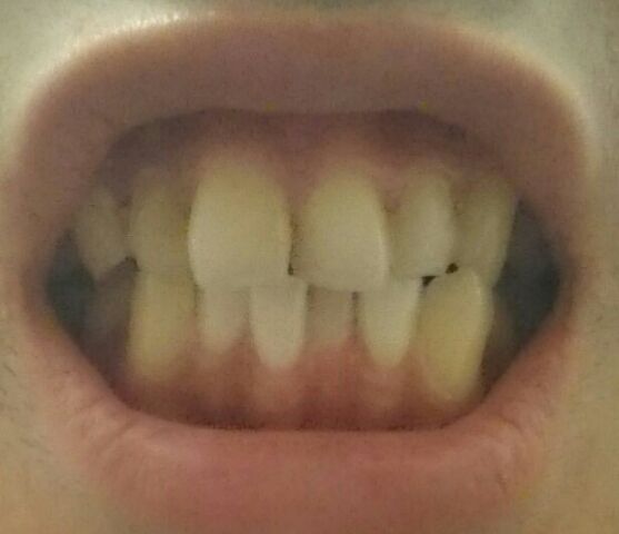 セルフホワイトニング前の自分の歯