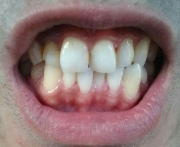 セルフホワイトニング後の自分の歯